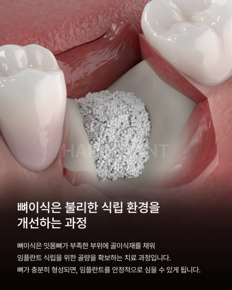 뼈이식임플란트 전 이런 점이 궁금하셨나요? 뼈이식임플란트과정과 기간, 통증까지 정리해드립니다 관련 이미지 4