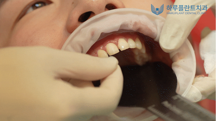 하루 만에 완성하는 자연스러운 심미치료, 하루네이트 관련 이미지 1