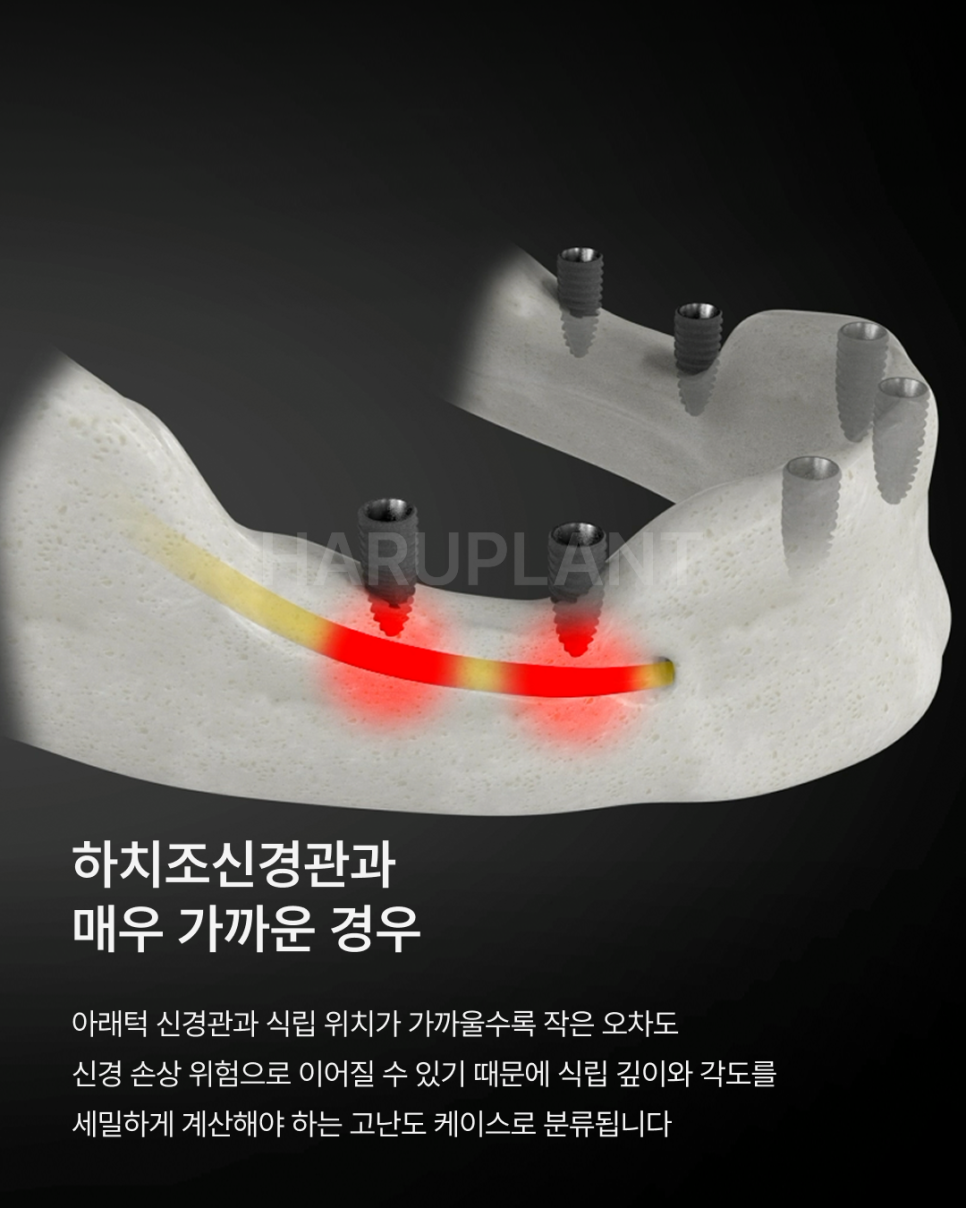 나도 고난도 임플란트 케이스일까? 상악동거상술부터 재수술까지 고난도임플란트종류 알아보기 관련 이미지 3