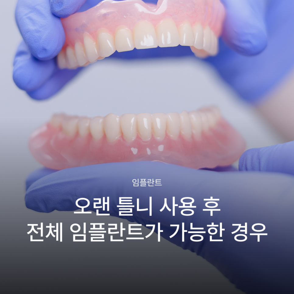 오랜 틀니 사용 후 전체 임플란트가 가능한 경우, 임플란트 종류와 전체 임플란트 뜻까지 관련 이미지 1