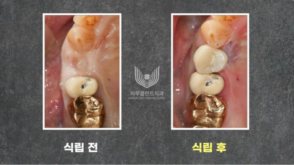 강남구 당일 임플란트 성공의 비결은? 관련 이미지 8