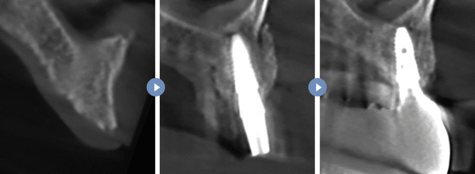 임플란트 뼈이식 수술 후기와 진행과정 공개 관련 이미지 3