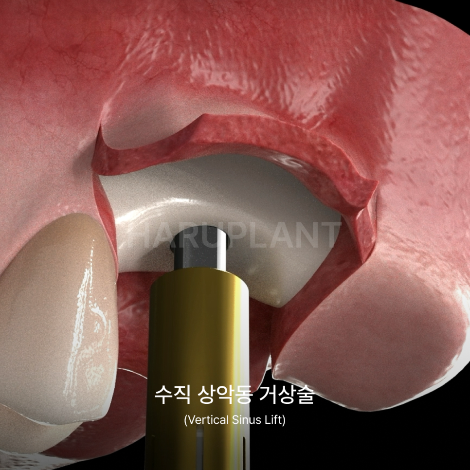 상악동거상술 뜻과 종류로 알아보는 위턱 어금니가 고난도임플란트가 되는 이유 관련 이미지 7