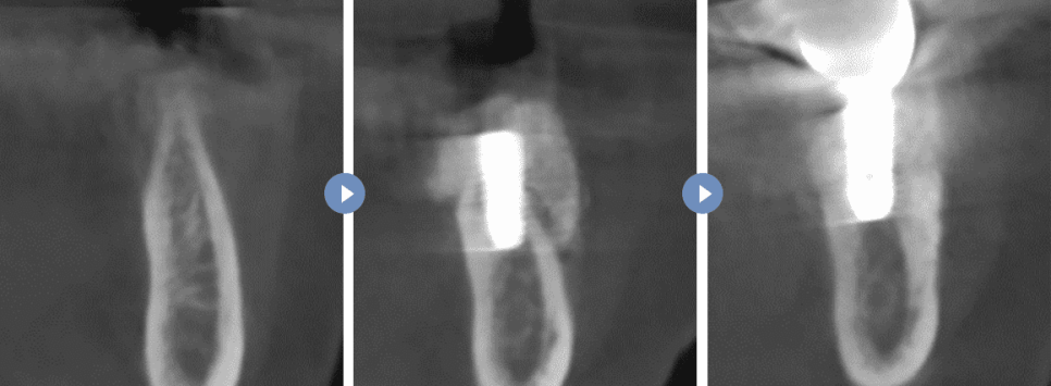 임플란트 뼈이식 수술 후기와 진행과정 공개 관련 이미지 5