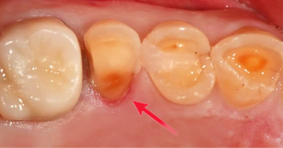 치과당일치료 하루플란트치과의 혁신적인 하루완성 클리닉 관련 이미지 9