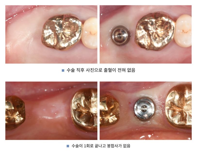 통증 줄이고 회복 빠른 하루플란트치과 CLS 무절개 임플란트 관련 이미지 3