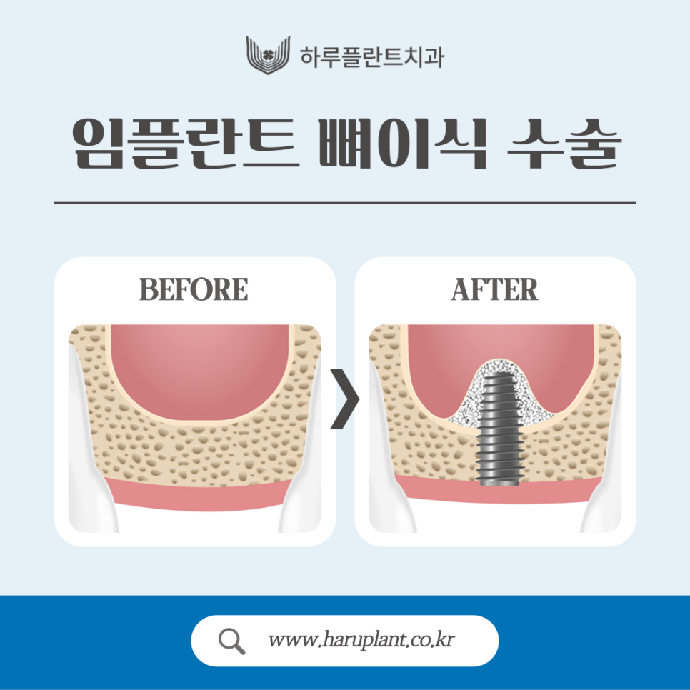 임플란트 뼈이식 수술 후기와 진행과정 공개 관련 이미지 1