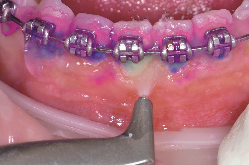 강남역스케일링 통증,시림 없는 프리미엄 에어플로우 스케일링 관련 이미지 15