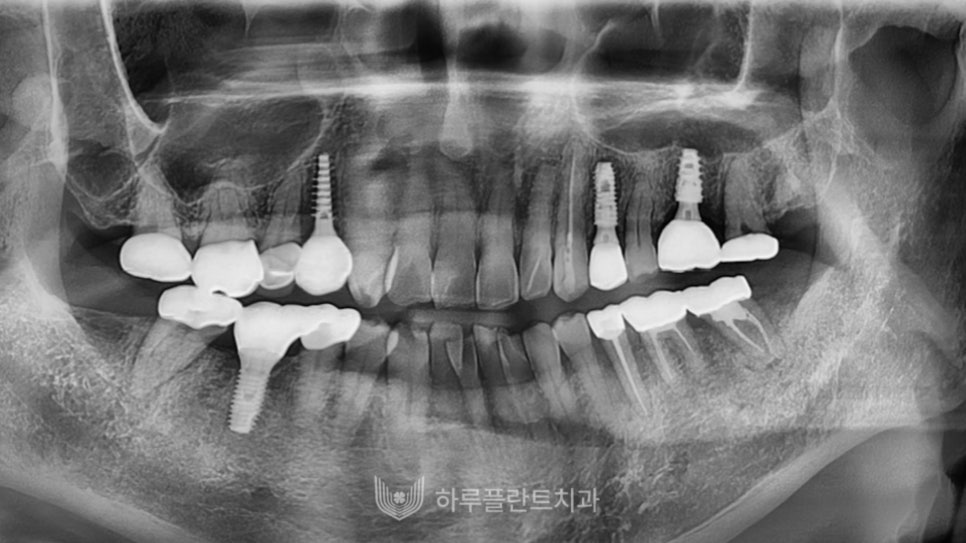 강남구 당일 임플란트 성공의 비결은? 관련 이미지 7