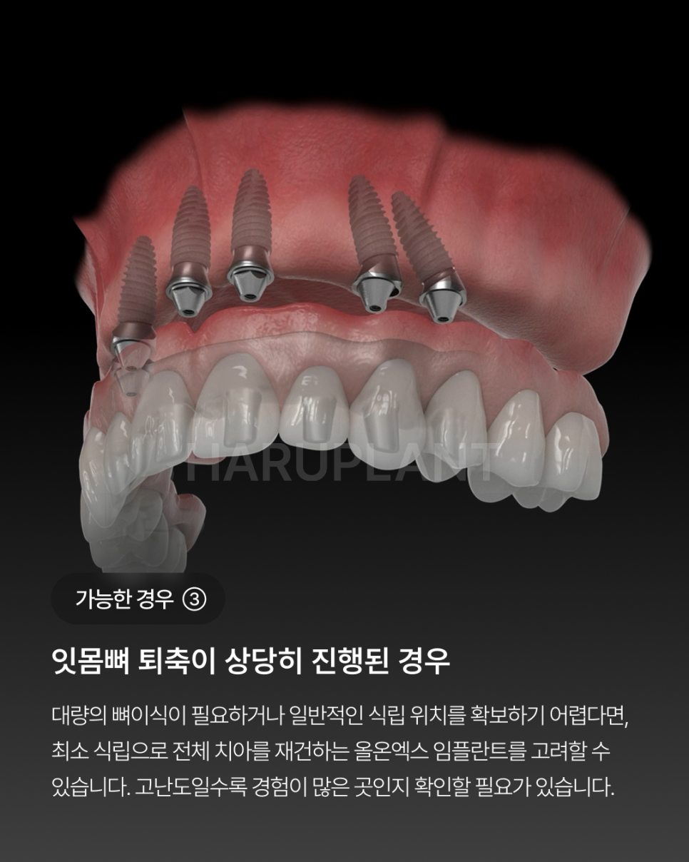 오랜 틀니 사용 후 전체 임플란트가 가능한 경우, 임플란트 종류와 전체 임플란트 뜻까지 관련 이미지 5