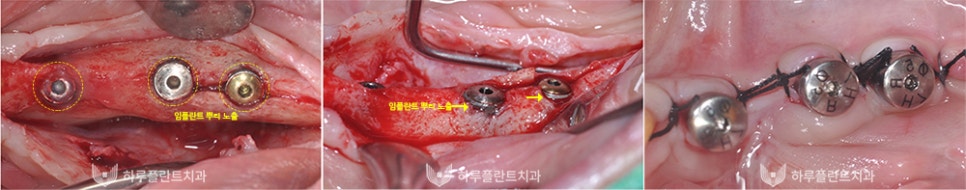 강남역치과 하루플란트치과 임플란트 주위염 원인부터 예방법까지 관련 이미지 6