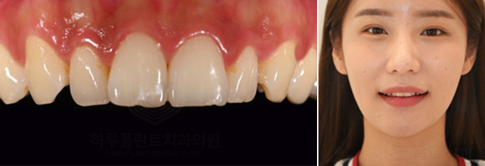 치과당일치료 하루플란트치과의 혁신적인 하루완성 클리닉 관련 이미지 6