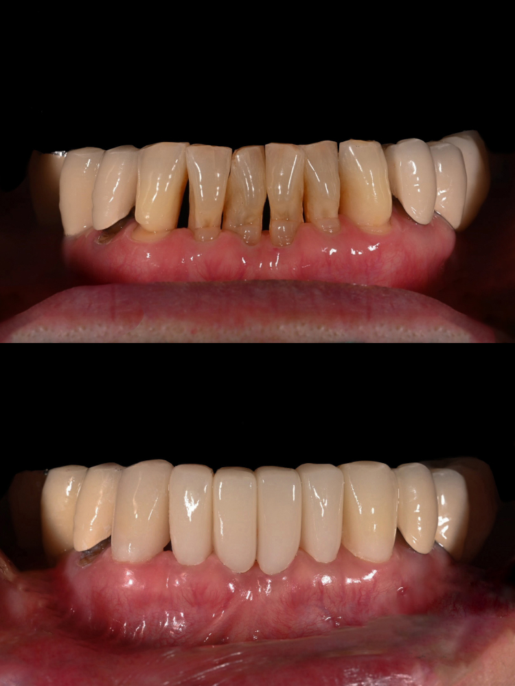 치아 사이 틈, 하루네이트로 해결할 수 있습니다 관련 이미지 6