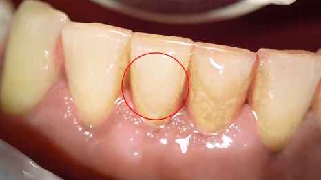 강남역스케일링 통증,시림 없는 프리미엄 에어플로우 스케일링 관련 이미지 12