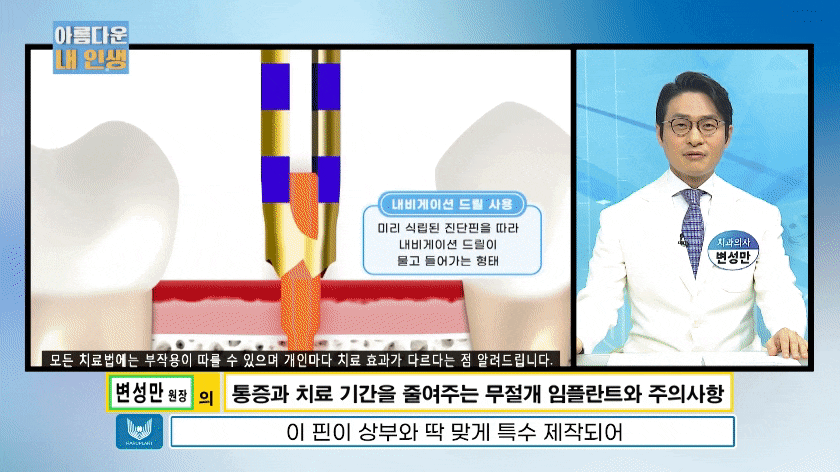 임플란트 전문가 변성만 원장 TV 출연 - 통증 줄인 무절개 임플란트 관련 이미지 11