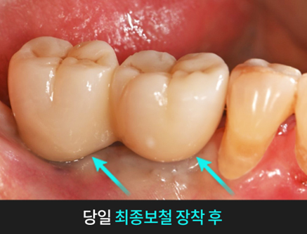 치과당일치료 하루플란트치과의 혁신적인 하루완성 클리닉 관련 이미지 5