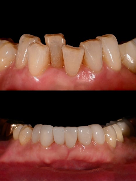 치아 사이 틈, 하루네이트로 해결할 수 있습니다 관련 이미지 8