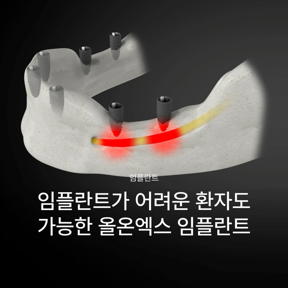 Why All-on-X Implants May Be Worth Considering Even If You Have Been Told That Full-Arch Implants Are Difficult image 1