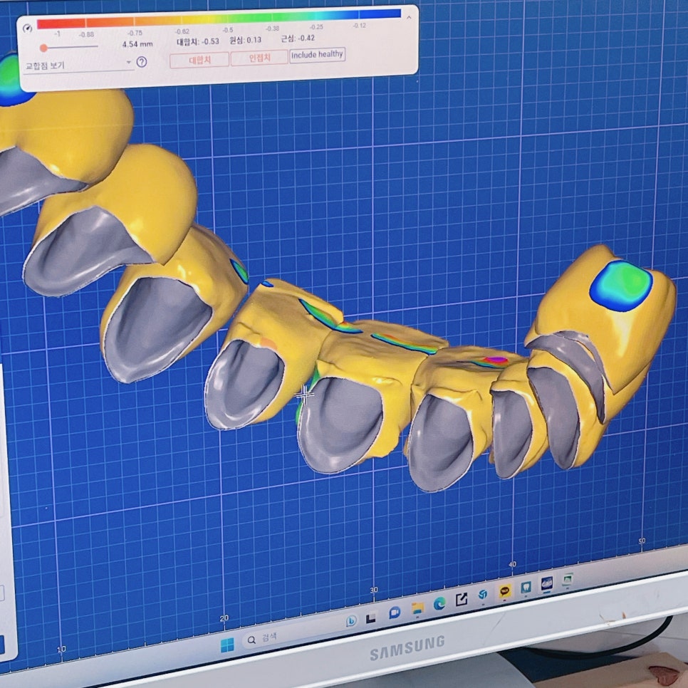 서초동치과 원내기공실이 있는 치과가 좋은이유 관련 이미지 2