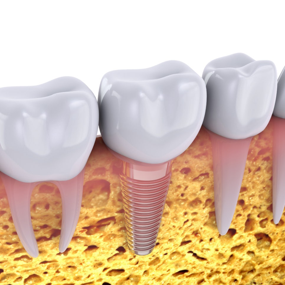 임플란트도 유통기한이 있다? 탄화수소가 임플란트에 미치는 영향 관련 이미지 3