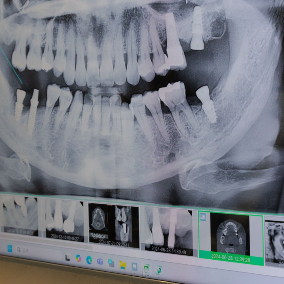 임플란트 회복기간, 빨라지는 비결? 하루플란트 플라즈마 임플란트가 도와드립니다! 관련 이미지 3
