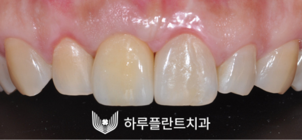 강남역 하루플란트치과 앞니 임플란트 후기 전후차이 관련 이미지 4