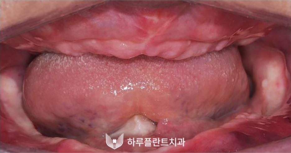 하루플란트치과 변성만 대표원장 타치과 임플란트 불가판정 성공사례 관련 이미지 7