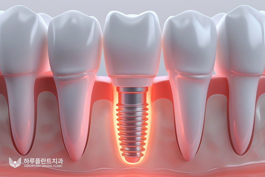 임플란트 수명 오래 유지하려면 이렇게 하세요 관련 이미지 3