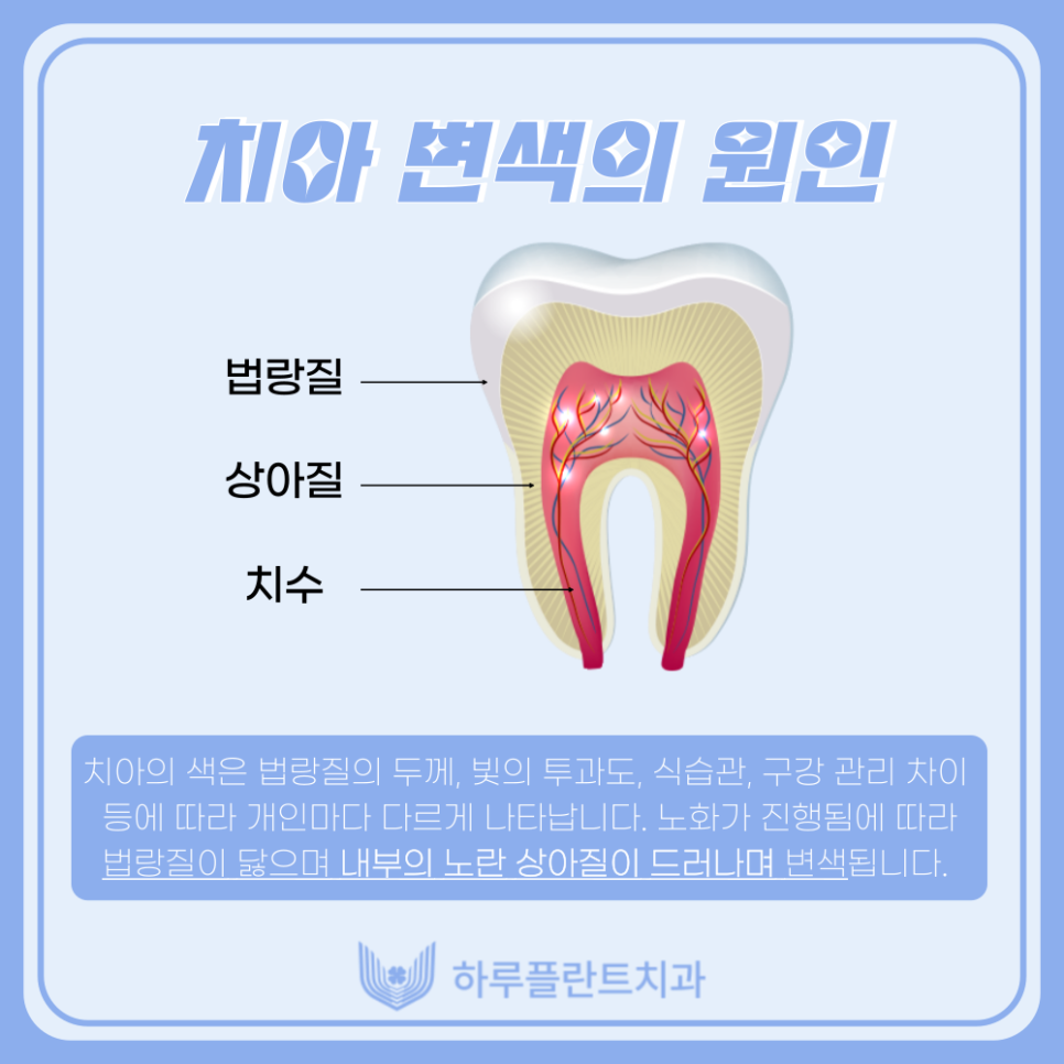 강남치과 하루플란트치과 치아미백 고민중이라면 관련 이미지 2