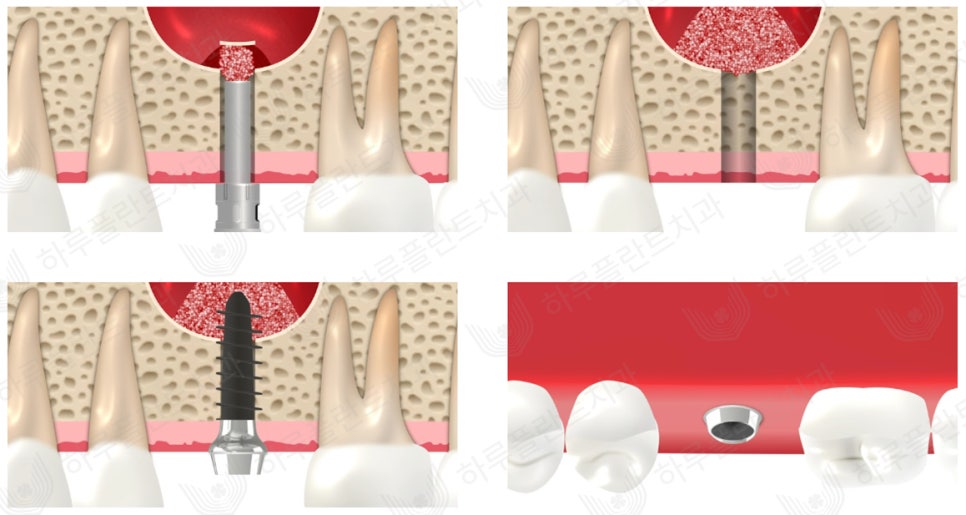 강남역 하루플란트치과 임플란트 무절개 상악동 거상술 진행 케이스 관련 이미지 4