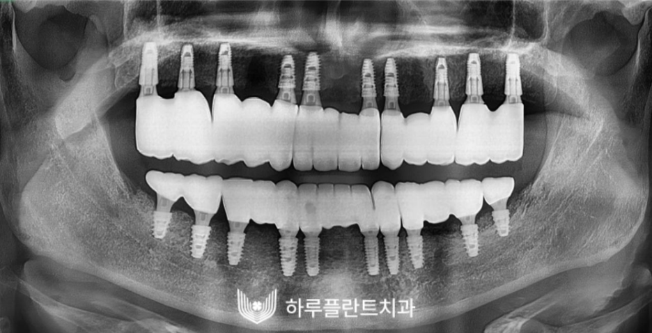 하루플란트치과 변성만 대표원장 타치과 임플란트 불가판정 성공사례 관련 이미지 8