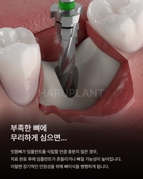 뼈이식임플란트 전 이런 점이 궁금하셨나요? 뼈이식임플란트과정과 기간, 통증까지 정리해드립니다 관련 이미지 3