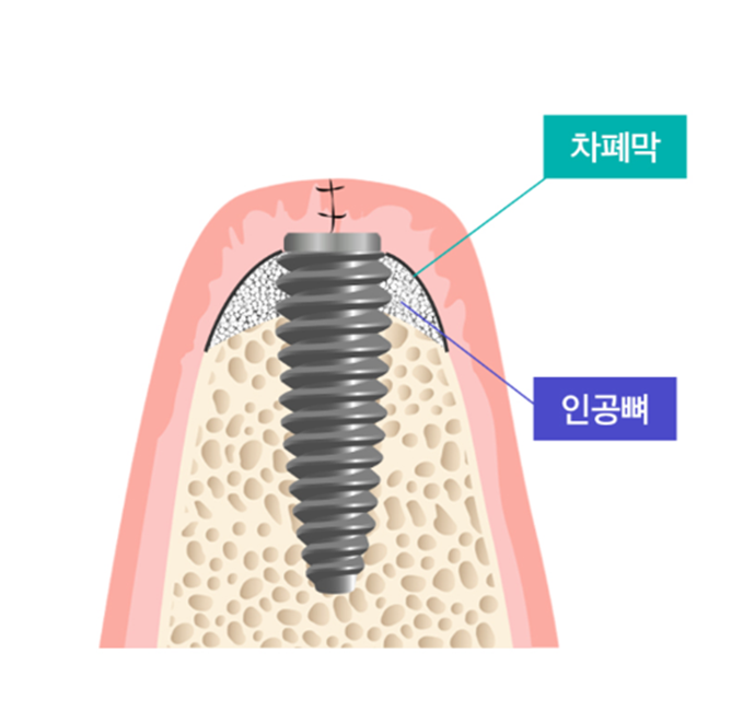 임플란트 뼈이식 수술 후기와 진행과정 공개 관련 이미지 4