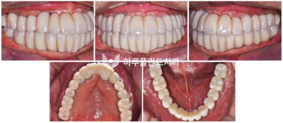 하루플란트치과 변성만 대표원장 타치과 임플란트 불가판정 성공사례 관련 이미지 9