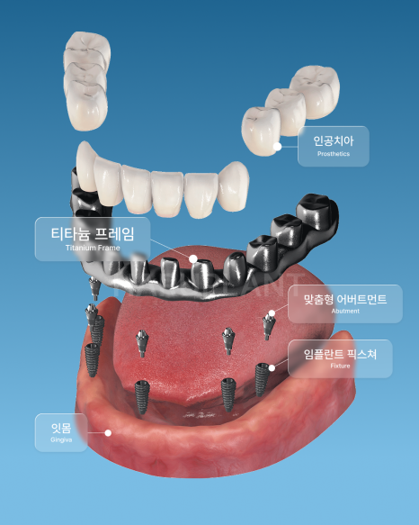 Why All-on-X Implants May Be Worth Considering Even If You Have Been Told That Full-Arch Implants Are Difficult image 9