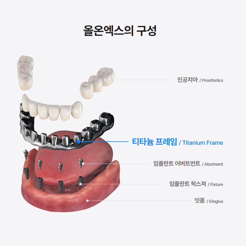 전체 임플란트가 부담된다면 이건 어떠세요? 하루플란트의 실속있는 올온엑스 임플란트 솔루션! 관련 이미지 4