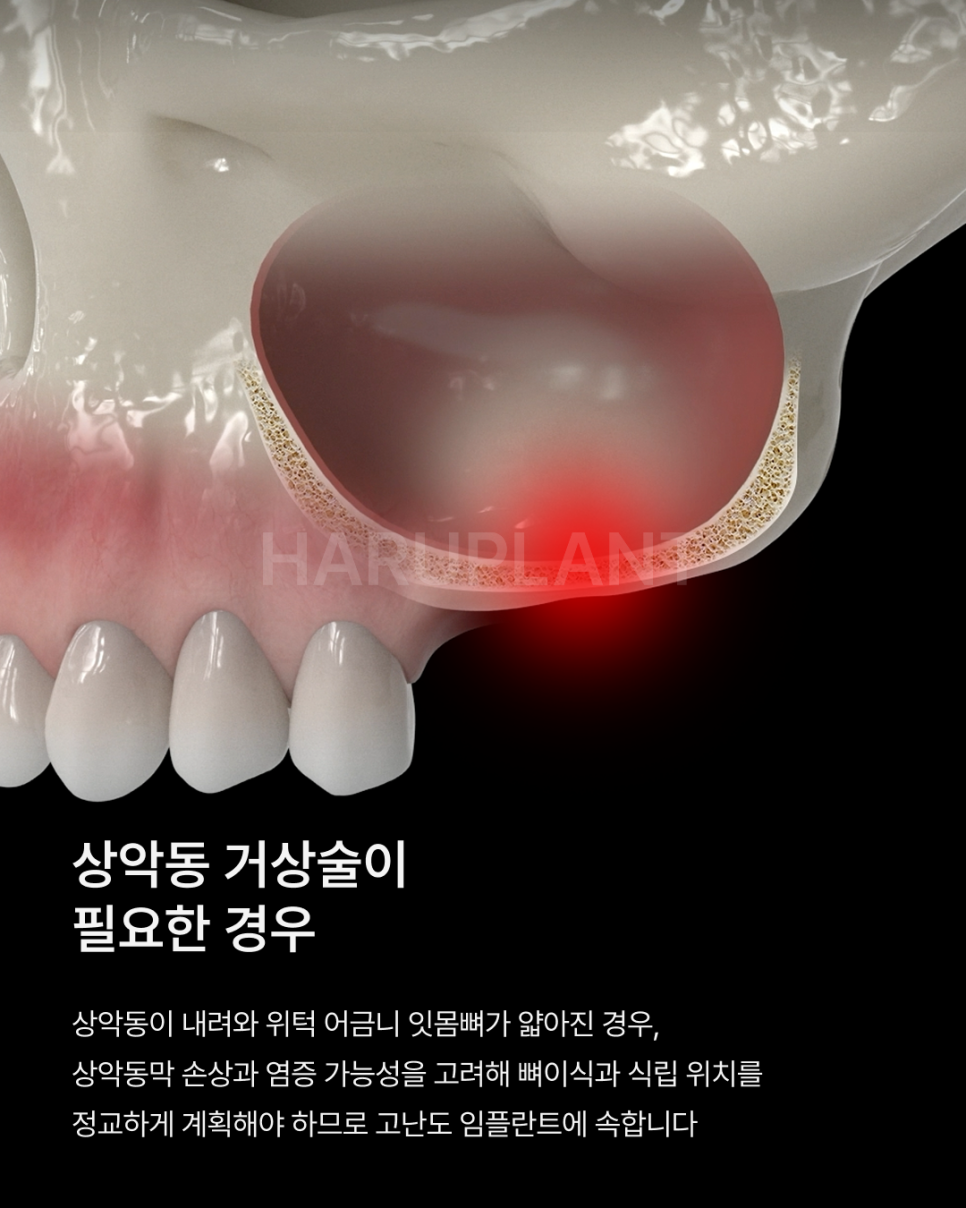 나도 고난도 임플란트 케이스일까? 상악동거상술부터 재수술까지 고난도임플란트종류 알아보기 관련 이미지 4