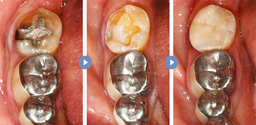 치과당일치료 하루플란트치과의 혁신적인 하루완성 클리닉 관련 이미지 12
