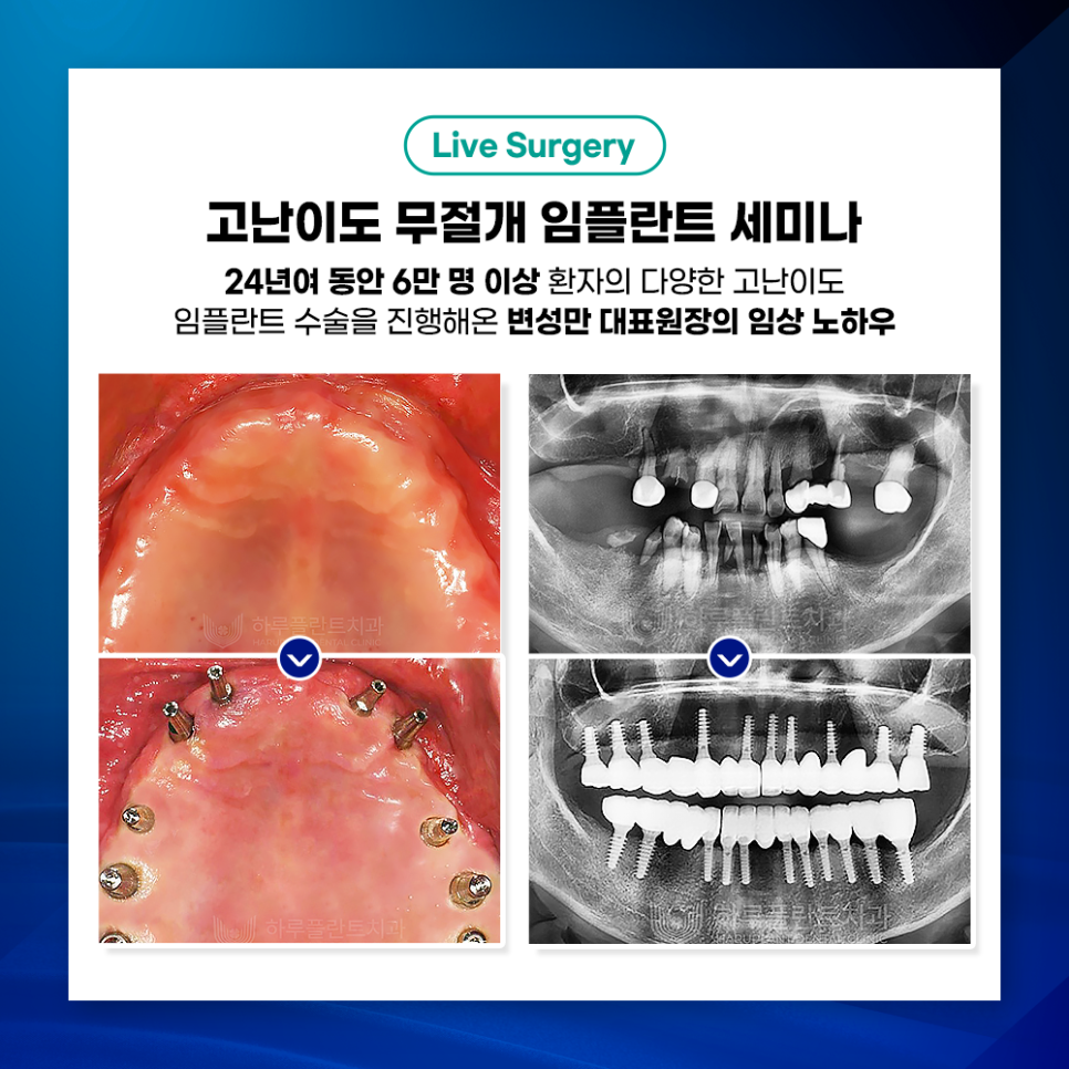 하루플란트치과 변성만 대표원장 무절개 임플란트 세미나 관련 이미지 6