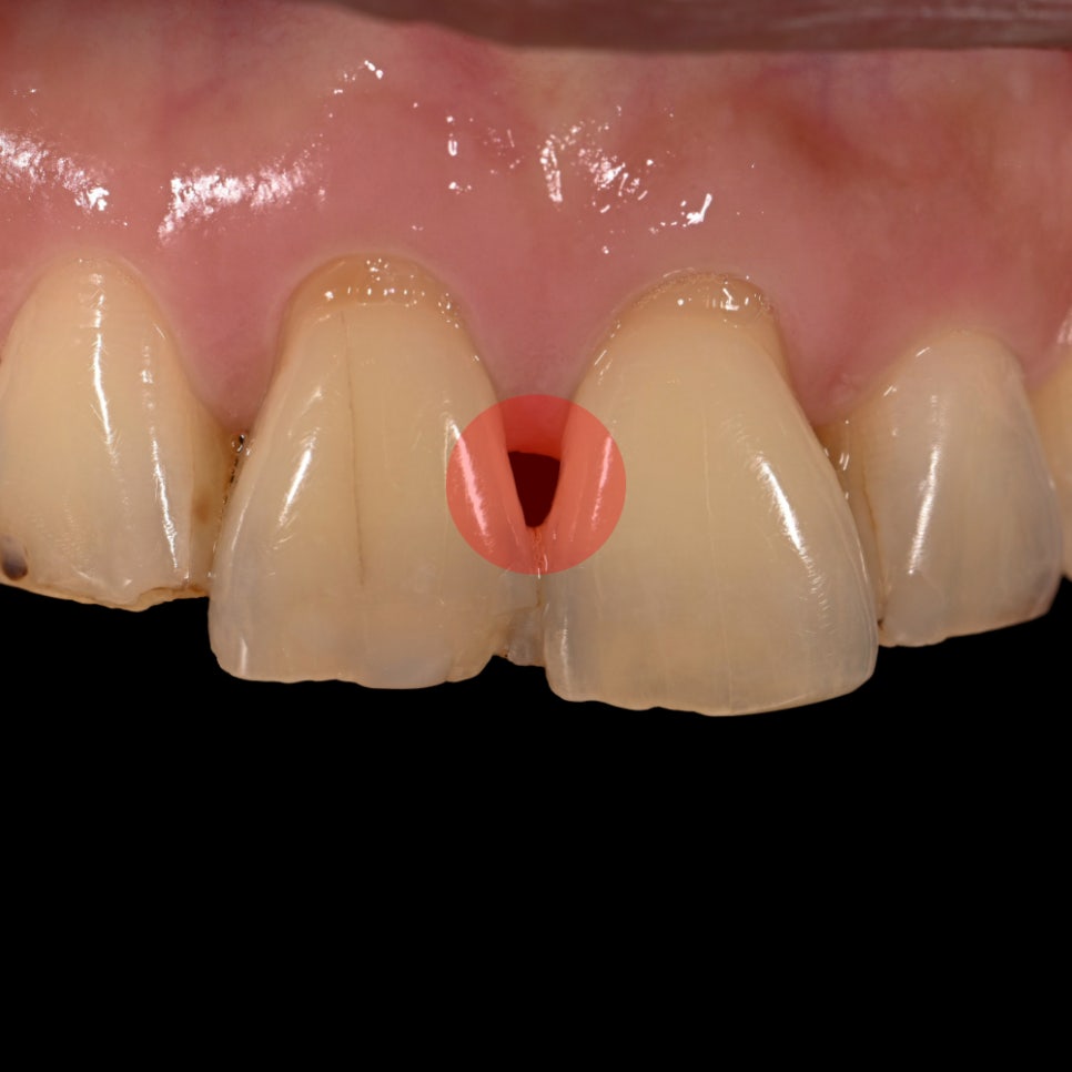 치아 사이 틈, 하루네이트로 해결할 수 있습니다 관련 이미지 2