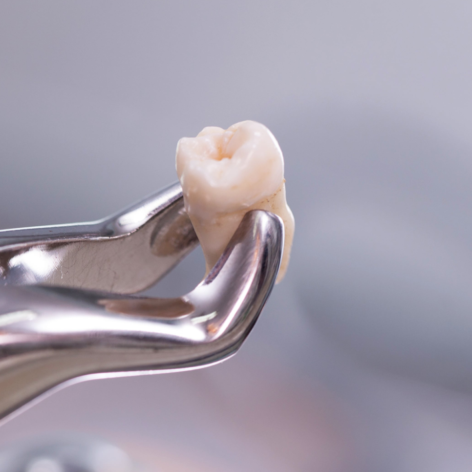 앞니 임플란트 고민 중이라면? 하루플란트와 함께 체크해야 할 사항, 세 가지 알아보기 관련 이미지 3