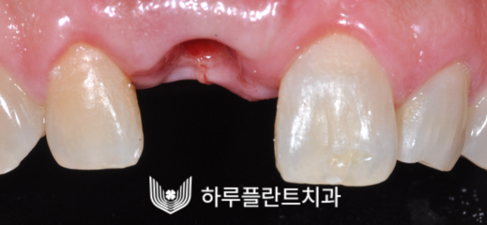 강남역 하루플란트치과 앞니 임플란트 후기 전후차이 관련 이미지 3