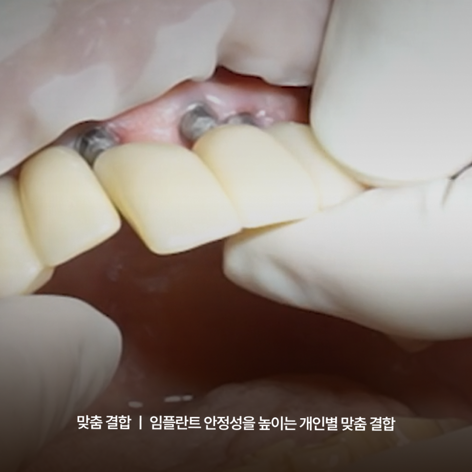 What to Look for When Choosing an Implant Dentist Near Gangnam Station—Find Out Through Haru Implant Dental Clinic’s Customized Care System image 7