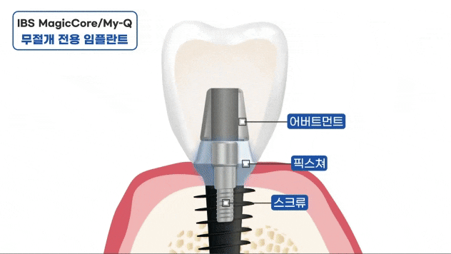 임플란트 평생 쓸 수 있나요? 오래 쓰는 방법 대공개(무절개 임플란트 수명) 관련 이미지 7
