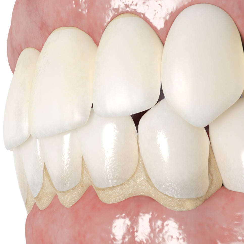 치아 사이 틈, 하루네이트로 해결할 수 있습니다 관련 이미지 3