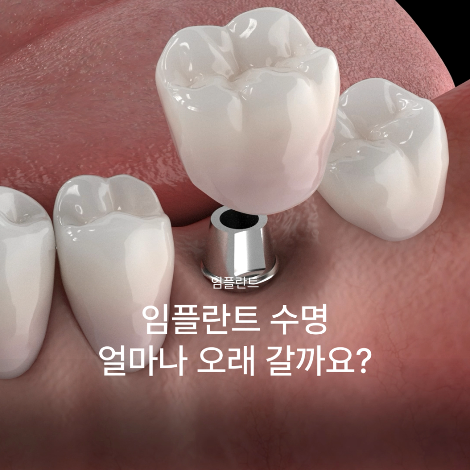 임플란트수명, 얼마나 오래쓸 수 있을까요? 관련 이미지 1