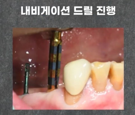 임플란트 전문가 변성만 원장 TV 출연 - 통증 줄인 무절개 임플란트 관련 이미지 12