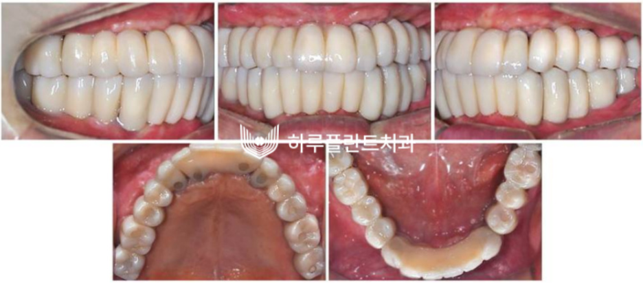 하루플란트치과 변성만 대표원장 타치과 임플란트 불가판정 성공사례 관련 이미지 5