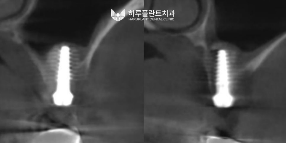 강남역 하루플란트치과 임플란트 무절개 상악동 거상술 진행 케이스 관련 이미지 9