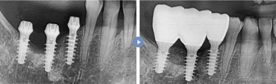 임플란트 뼈이식 수술 후기와 진행과정 공개 관련 이미지 7